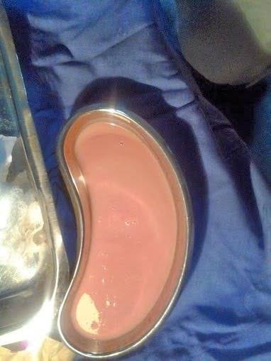 DrAkhilX's tweet image. A patient with dysentery and liver abscess.

Colon biopsy and abscess aspirate are shown.

What is this❓️