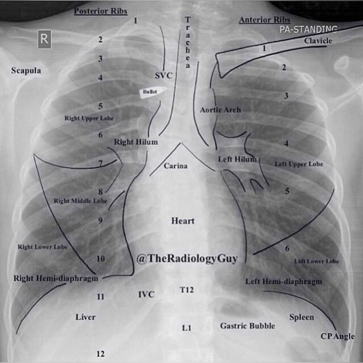 Chest X-ray Interpretation