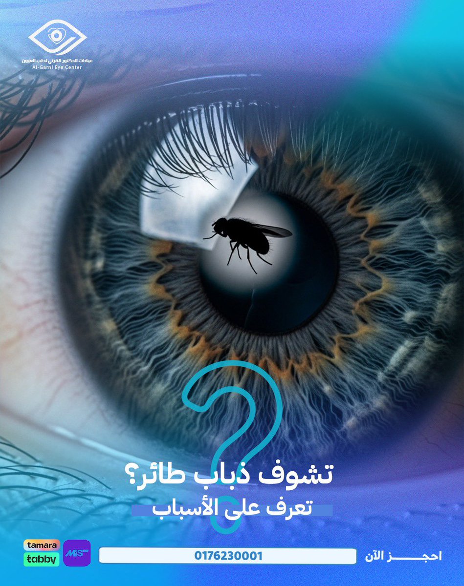 إذا لاحظت أحيانًا نقاط أو خيوط سوداء تتحرك أمام نظرك وكأنها "ذباب طائر"؟ 🪰
لا تقلق، فهي من الأعراض الشائعة جدًا 

-  الأسباب المحتملة:

. تغيّرات طبيعية في السائل الزجاجي داخل العين (تزداد مع التقدم في العمر).

. قصر النظر الشديد.

. بعد عمليات العيون أو التعرض لإصابة.

. في بعض
