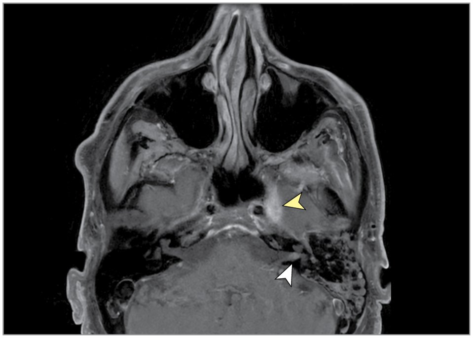 JAMAOnc's tweet image. A 78-year-old man with a history of nonmelanoma skin cancers presented with left-sided upper and lower facial weakness. What is your diagnosis? ja.ma/49DWPs8