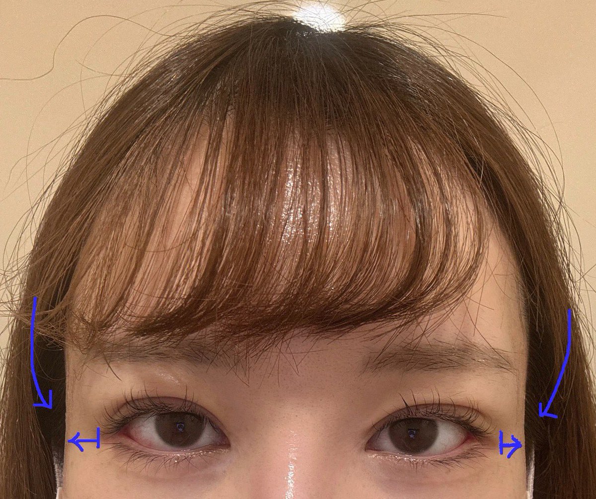 2_kl5's tweet photo. 📝術後２週間目
目付き矯正&amp;ワンダー目尻切開（横幅拡大、目尻下げ）

施術から2週間経過しました。
腫れや赤みは徐々に引き、自然な仕上がりになってきています。
目の横幅が広がったことで、目尻の横の余白が少なくなり、小顔に見えるようにもなりました🫧 https://t.co/IC1ZYeq1ve