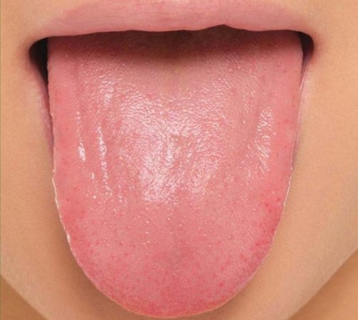 كثير يسألون عن شكل اللسان لشخص طبيعي ليس لديه امراض ..
هذا هو شكل اللسان لشخص ليس لديه امراض مزمنة على الأقل و لا يشتكي من اي خمول او حرارة داخليه في الجسم و لا برودة داخليه في الجسم 

طبعا هذي ما اشوفها مع المرضى .. هذي اشوفها مع مرافقين المرضى 😅😅

مين عنده نفس هذا اللسان؟ ان