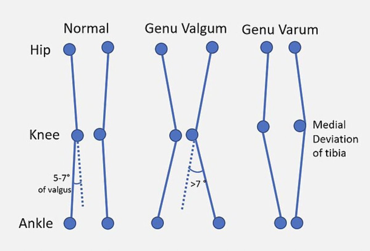 USMLEStepStudy's tweet image. Genu Varum (Bowlegs): Standing gap between knees. Common in toddlers, usually resolves by age 2.
Genu Valgum (Knock-Knees): Knees touch, ankles apart. Peaks age 4-5, often corrects by age 7-8.
Rx: RARELY needed. Bracing/surgery only for severe, persistent or underlying disease.