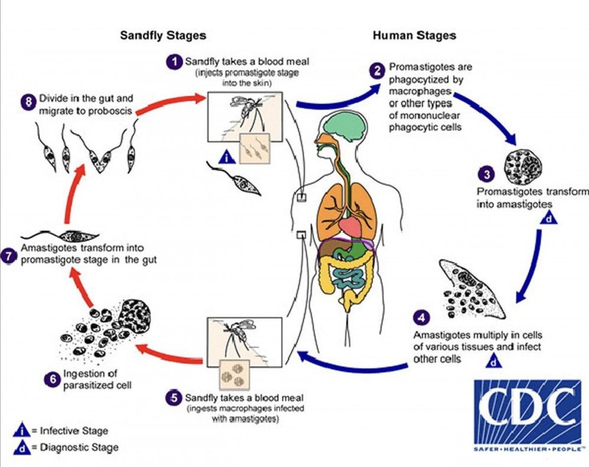 USMLEStepStudy's tweet image. Leishmaniasis: parasitic dz spread by sand fly bites 🦟
▶️ Cutaneous: Skin ulcers at bite site (MC)
▶️ Mucocutaneous: mouth/nose mucous membranes
▶️ Visceral: Fever, wt loss, splenomegaly, hepatomegaly
Rx: 💊 Antiparasitic liposomal amphotericin B