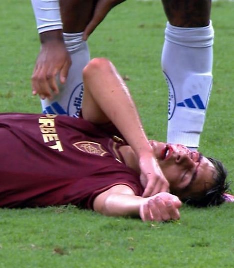 CentralDoBrega's tweet image. e tome mais um erro de arbitragem no Brasileirão 

Matheus Pereira já tinha amarelo, acertou uma cotovelada no rosto do Bernal (que ficou sangrando) e não levou o segundo amarelo

parabéns arbitragem 👏🏻👏🏻👏🏻