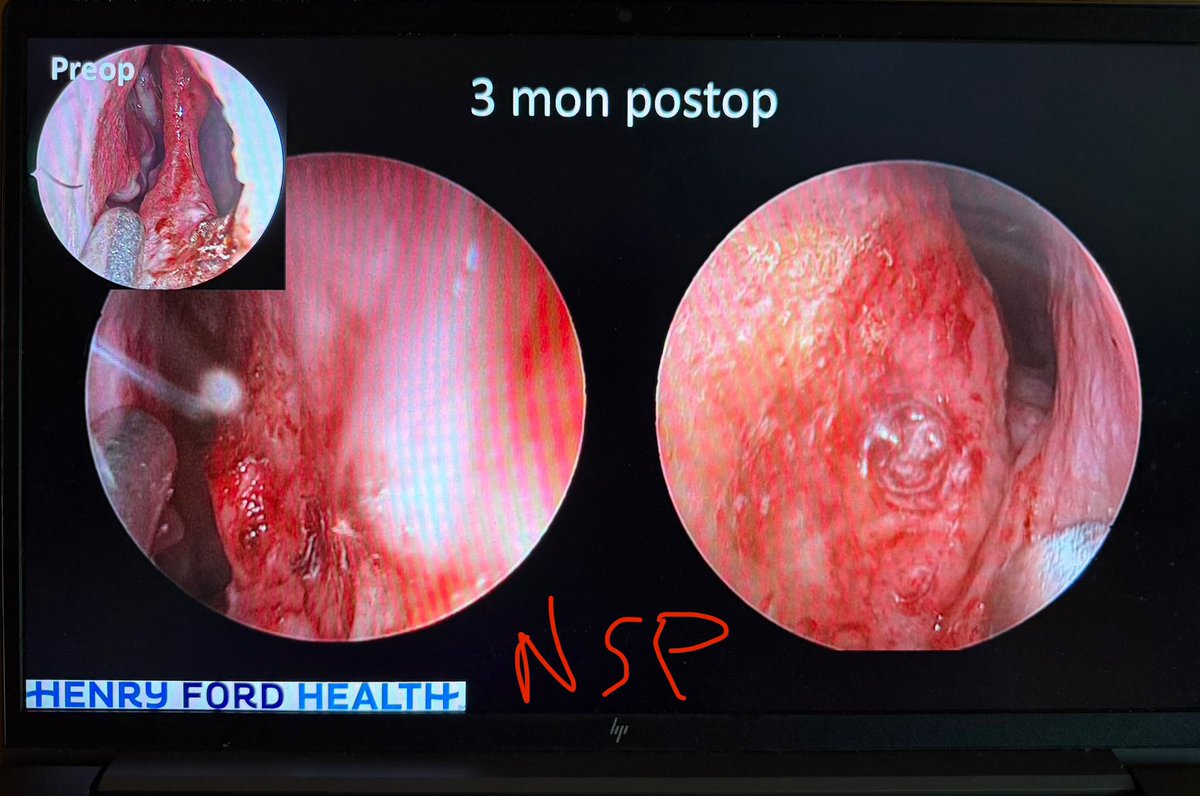 As we enter the week of #PanamOTO2025 in Santiago 🇨🇱, been getting my mind and spirit right up in the #Andes and #Pirque 🍷 country ahead of mtg. But gearing up for #ODS Wed and #SeptalPerfs Fri! 😎😂🔥 <a href="/ent_ams/">Alberto Maria Saibene, MD, MA</a> <a href="/MartaKwiat_ska/">Marta Kwiatkowska, MD, PhD</a>
