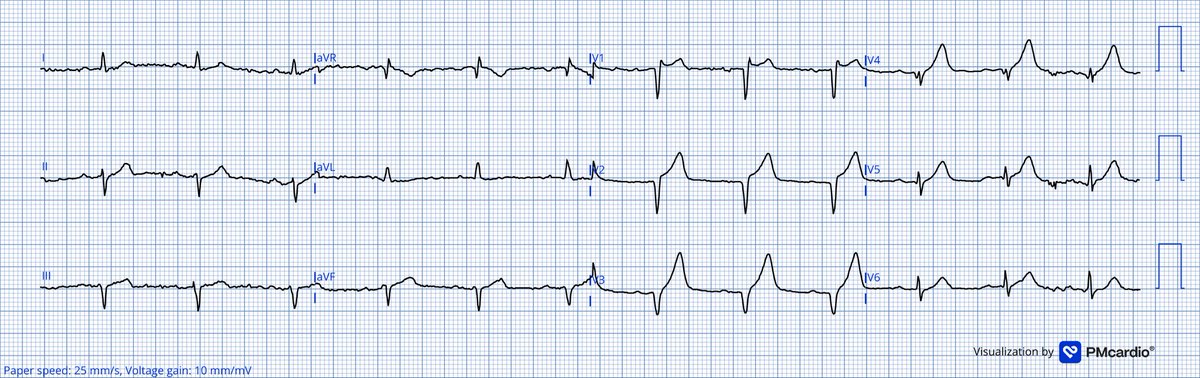 TheECGMedic's tweet image. We all know this is not a STEMI. 
We all know this is OMI.

The challenge is - what’s the culprit and a double challenge is what’s the TIMI flow?

#ECG #ECGChallenge