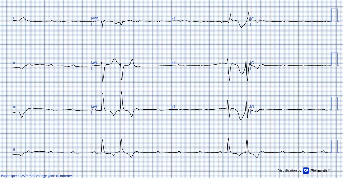 TheECGMedic's tweet image. What do you see here?

If you’re not feeling dizzy looking at this, I’m sure the patient is on your behalf!

#ECG #ECGChallenge