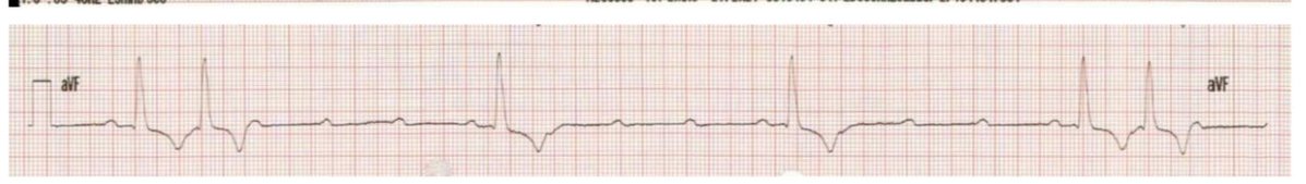 TheECGMedic's tweet image. What do you see here?

If you’re not feeling dizzy looking at this, I’m sure the patient is on your behalf!

#ECG #ECGChallenge