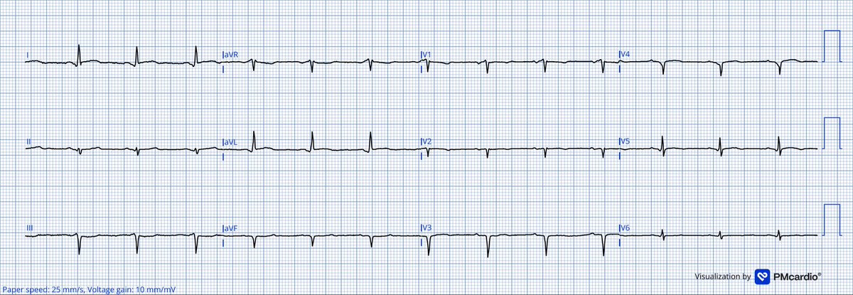 TheECGMedic's tweet image. No clinical information. What do you think of this ECG?

#ECG #ECGChallenge