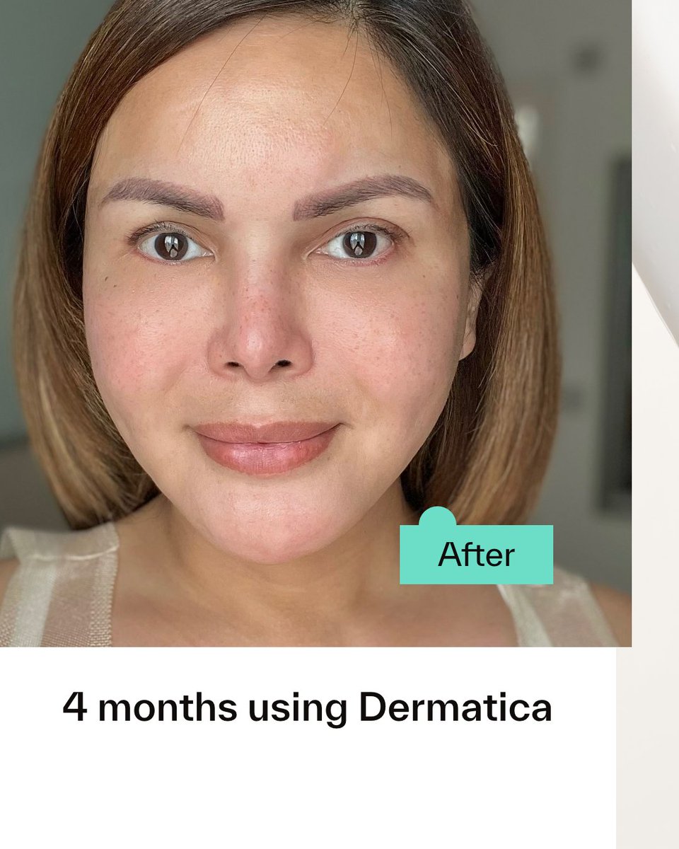 🗣Name: Angela
❤️Skin concern: Anti-aging
⏰Treatment length: 4 months