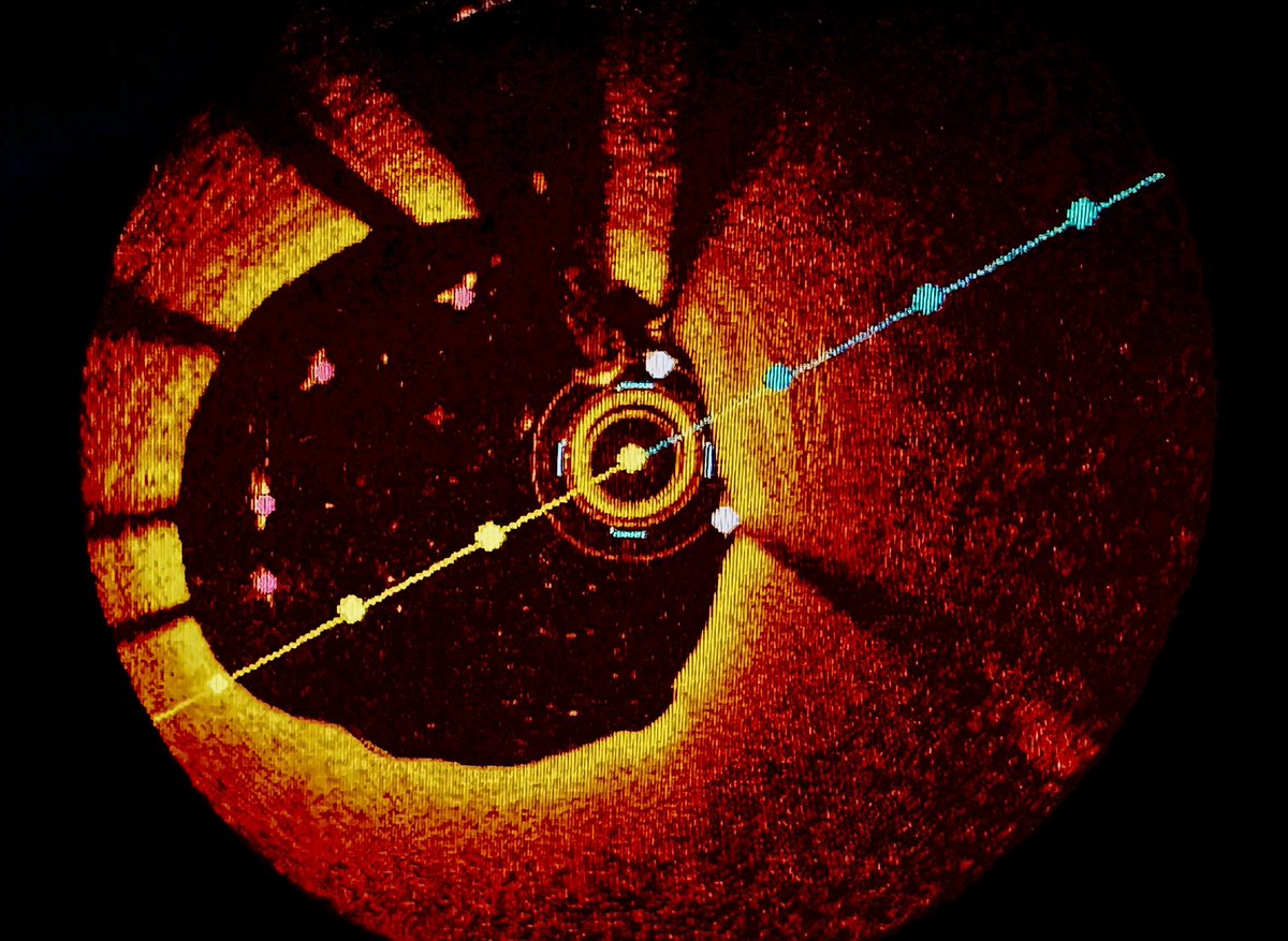nualik's tweet photo. Stent malapposition https://t.co/B0gXLElfw9