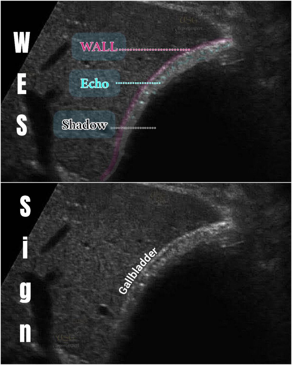EchoTech_4's tweet image. WES sign &amp;gt;&amp;gt; filled Gallbladder with stones.

#Ultrasound #EchoTech #POCUS