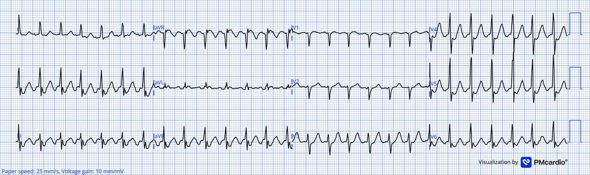 TheECGMedic's tweet image. What’s the rhythm!

#ECG #ECGChallenge