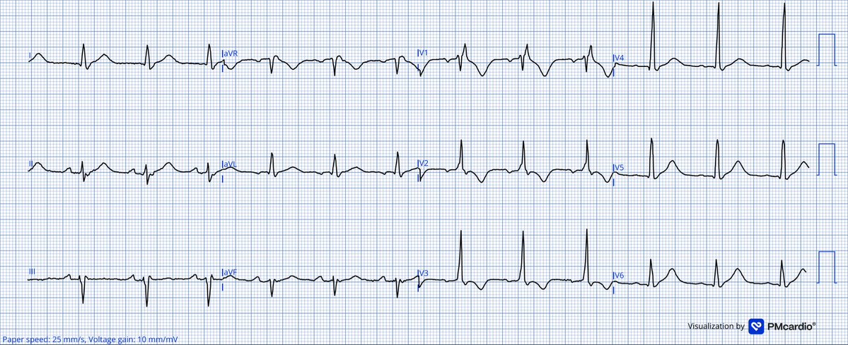 TheECGMedic's tweet image. 4 patients with chest pain.

Who needs to go to the cath lab?
Nobody? All of them? 

Answer in a few days!

#ECG #ECGChallenge