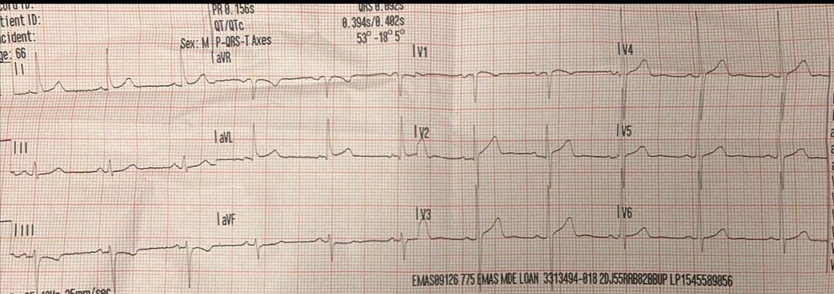 TheECGMedic's tweet image. 4 patients with chest pain.

Who needs to go to the cath lab?
Nobody? All of them? 

Answer in a few days!

#ECG #ECGChallenge