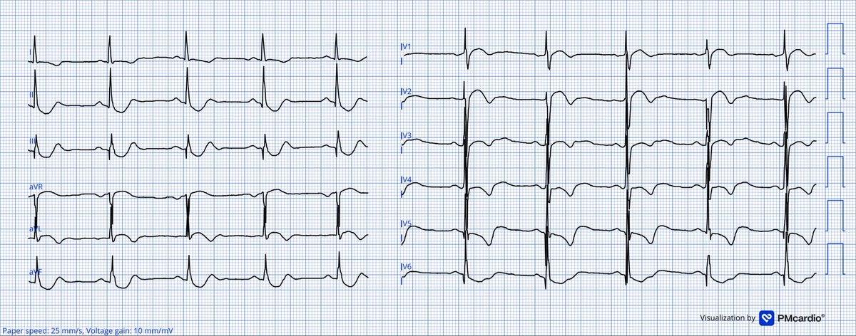 TheECGMedic's tweet image. 4 patients with chest pain.

Who needs to go to the cath lab?
Nobody? All of them? 

Answer in a few days!

#ECG #ECGChallenge