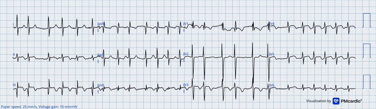 TheECGMedic's tweet image. 4 patients with chest pain.

Who needs to go to the cath lab?
Nobody? All of them? 

Answer in a few days!

#ECG #ECGChallenge