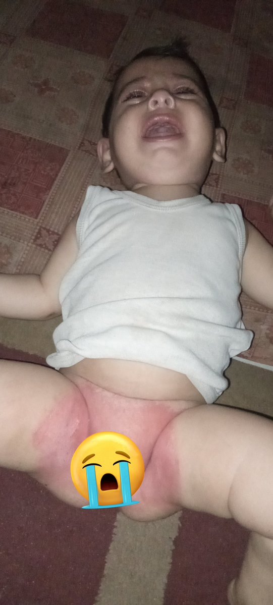 Please, I am unable to provide treatment for my child.#Gaza chuffed.org/project/150407… 😭💔🙏🙏🙏🙏