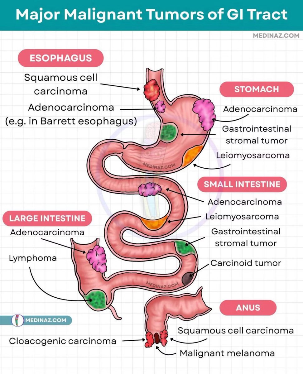 Malignant tumors of the GI tract

Source: Medinaz Academy