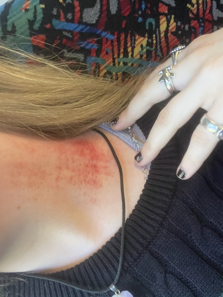 Levi_IsaFreak's tweet image. #shtwt I scratch whenever my social anxiety gets bad