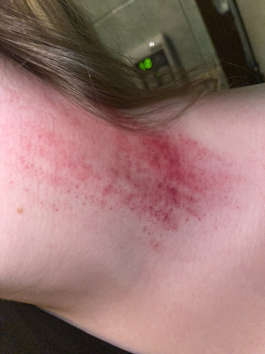 Levi_IsaFreak's tweet image. #shtwt I scratch whenever my social anxiety gets bad