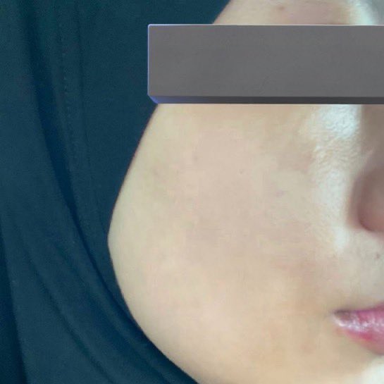 _zhraxs's tweet photo. Rugi betul tak try probiotic kalau skin tak clear, especially area pipi &amp; dagu cos 90% of the time it’s not your skin care 🤧

please get yourself a probiotic for skin &amp; watch your face glow! I know a good one! https://t.co/OOPkgRSa7f