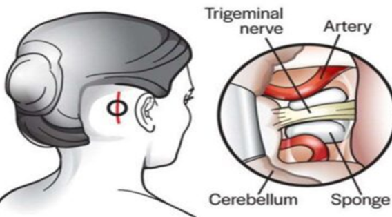 drsujoysanyal's tweet image. Raising Awareness about Trigeminal Neuralgia: The Suicide Disease - drsujoysanyal.com/raising-awaren…

 #trigeminalneuralgia #trigeminalneuralgiaspecialist #trigeminalneuralgiatreatment #TrigeminalNeuralgiaAwareness #TheSuicideDisease #neurosurgeon #neurosurgery