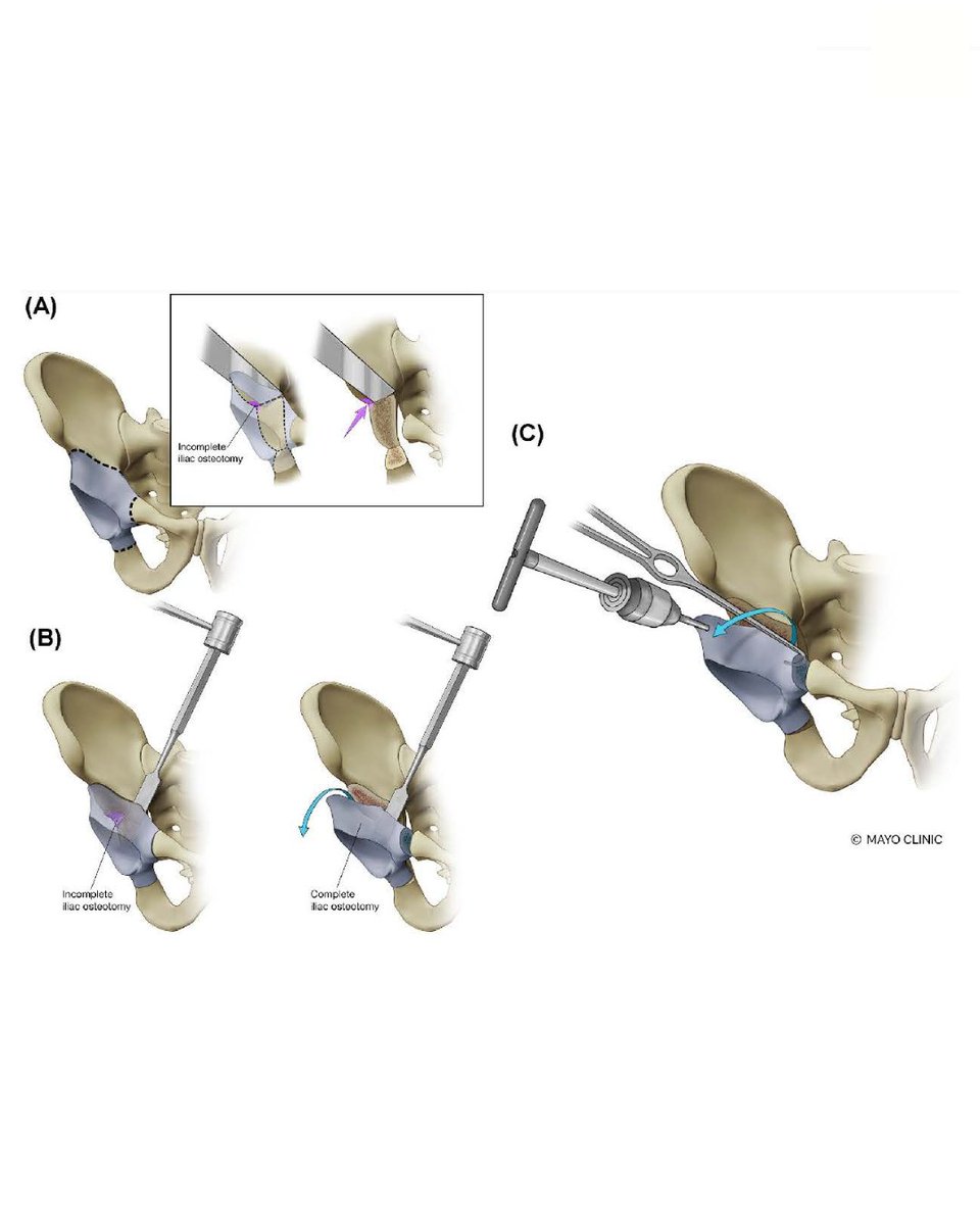 BoneJointOpen's tweet photo. Periacetabular osteotomy is effective for hip preservation, but carries a risk of complications. Awareness of potential complication types, recognition of risk factors, and meticulous surgical technique can help improve patient safety and outcomes.

#BJO

https://t.co/PzA6Anzash https://t.co/maWOB6CvpK