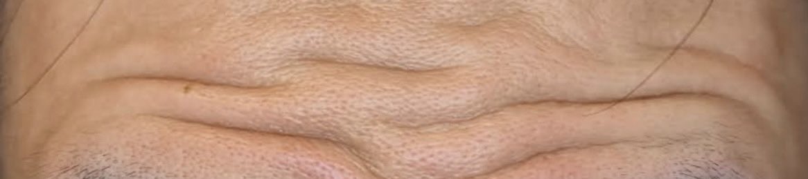 kei9305115910Hm's tweet image. 額の皺の入り方で疑問に思っているんだけど、1枚目みたいな細かく幅の狭い皺と2枚目の幅が広い皺とはどんな肌の違いがあるんだろう？薄肌と厚肌の違いでこうなるのかな？無知すぎて恥ずかしいが🫨そして拾い画ですみません🙇