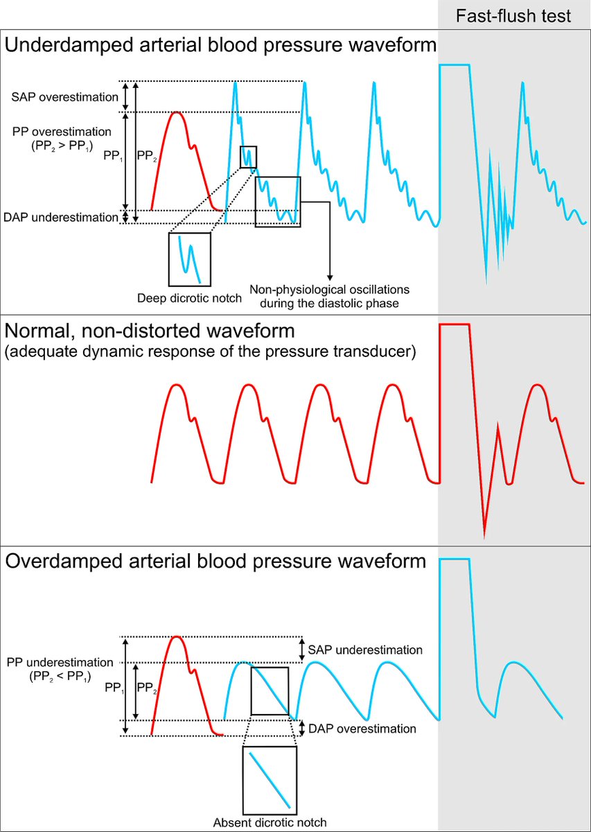 Today's Paper of the Day is:

Haemodynamic monitoring during noncardiac surgery: past, present, and future

criticalcarereviews.com/latest-evidenc…

Join us to read 1 paper per day and stay up-to-date as we cover the spectrum of critical care across 2025