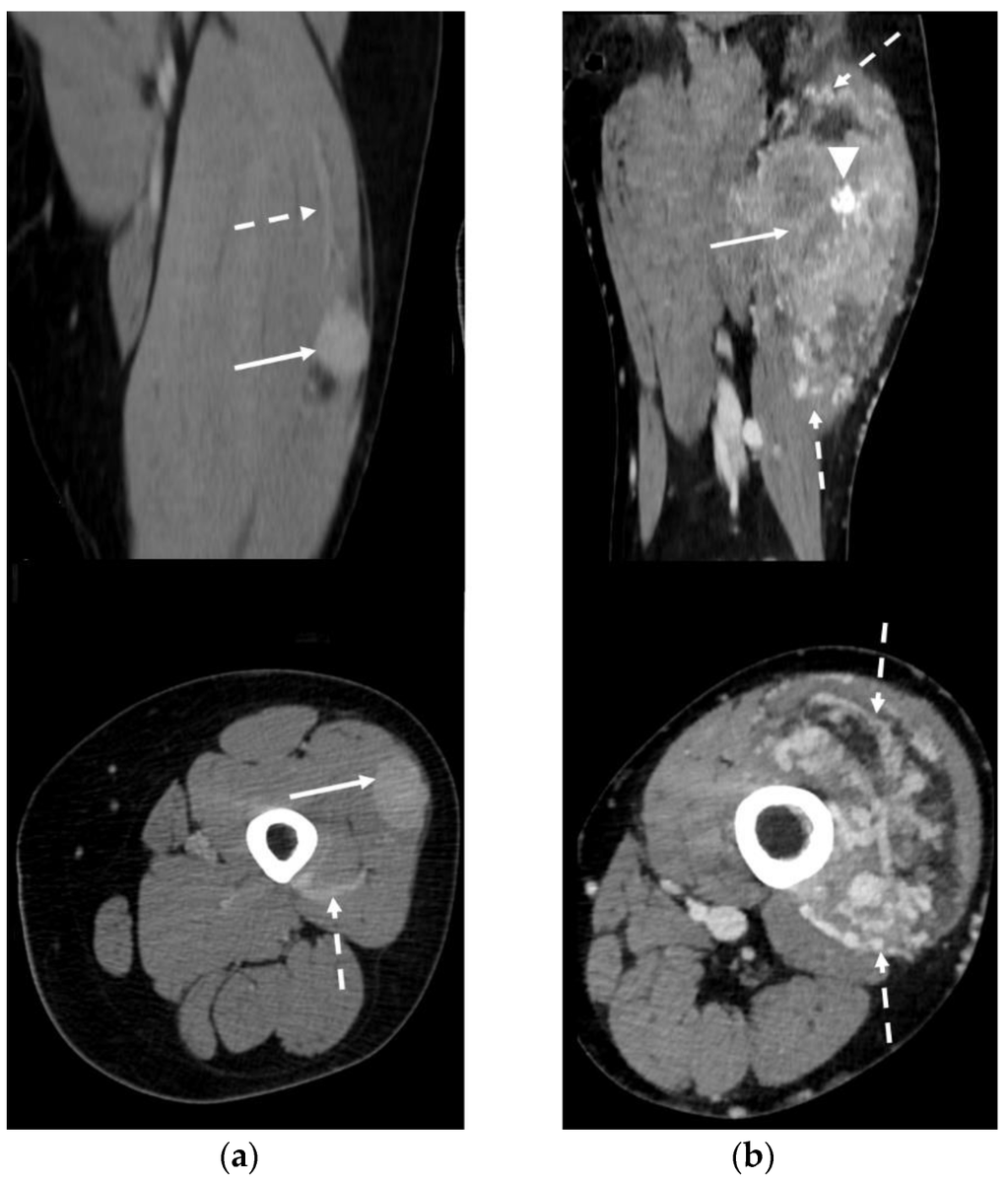 🚨 We Invite You to Read an Interesting Review
"Imaging Features of Alveolar Soft Part Sarcoma: Single Institution Experience and Literature Review"
📚 By Paolo Spinnato et al.
👏 11 Citations and 3240 Views!
🔗 brnw.ch/21wXlSF
#AlveolarSoftPartSarcoma #SoftTissueSarcoma