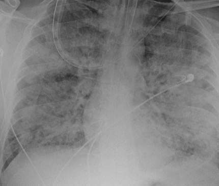 IM_Crit_'s tweet image. ICU #ARDS Secrets:

Our body&apos;s organs do not care about the PF ratio

#foamed #foamcc #meded #MedTwitter