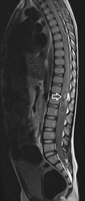 🧒A 6-year-old boy presented with intermittent episodes of urinary retention and constipation, without pain or limb weakness. Previous imaging had suggested diastematomyelia, but new studies revealed a different underlying spinal pathology.

🧑‍⚕️What’s the diagnosis?