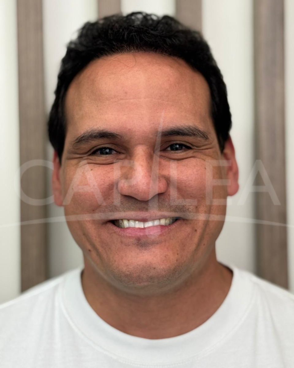 Aviso COFEPRIS 2319012002A00017
#drhectortreviño #capilea #capileamonterrey #hairtrasplant #injertocapilar #microinjertocapilar  #fuetechnique #trasplantecapilar   #capileatijuana #capileacdmx #drhectortrevino #capileamexico #hairtrasplantsurgeon