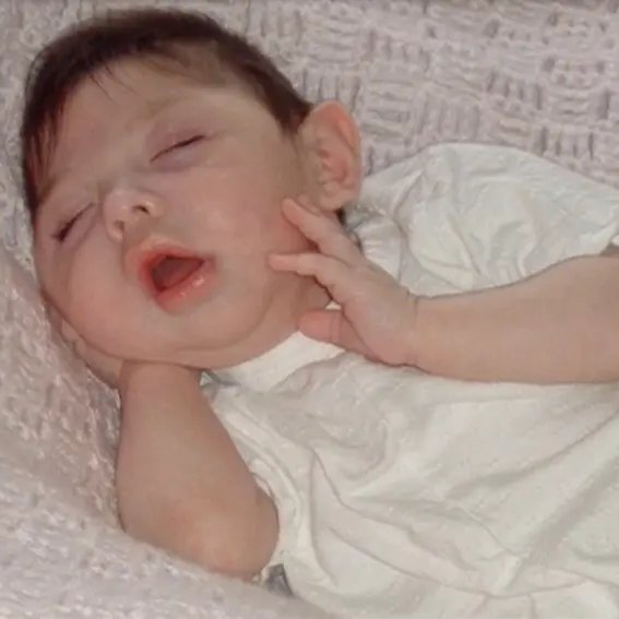 Cultination1's tweet photo. 🇺🇸 Un « MIRACLE médical » : Elle n’aurait jamais dû vivre plus de 6 mois, mais cette femme née sans cerveau fête ses 20 ans aux États-Unis.

Alex Simpson n’aurait dû vivre que 6 mois, un an tout au plus, comme tous les bébés touchés par cette maladie rare. Elle souffre d’hydranencéphalie, une maladie rare caractérisée par l’absence de développement des hémisphères cérébraux, qui sont remplacés par des poches contenant du liquide céphalorachidien. En d’autres termes, son cerveau est inexistant ou presque.

Cette pathologie touche à peine 1 bébé sur environ 100000 aux États-Unis. Malgré l’absence quasi totale de cerveau, Alex est plus consciente que les gens ne le croient. Elle peut percevoir et pressentir les choses qui se passent autour d'elle.

Le record de longévité pour une personne souffrant d’hydranencéphalie est de 32 ans, mais sous état végétatif.
 (Le Parisien & People)