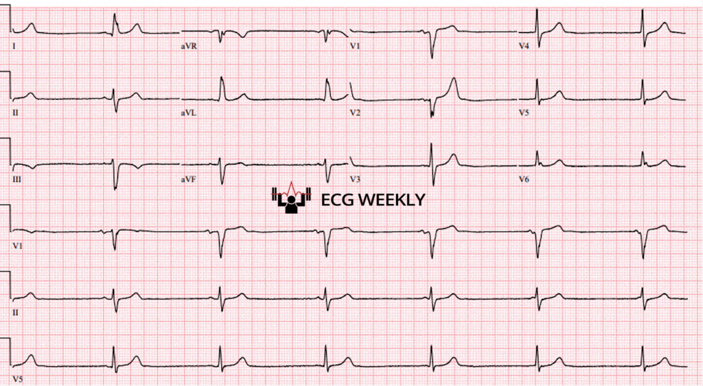 A 67 yo man arrives at the emergency department complaining of lightheadedness. The following ECG is obtained and shows a slow, regular rhythm around 40 beats per minute. The P waves seem to wander closer to and farther from the QRS complexes....ecgweekly.com/weekly-workout…