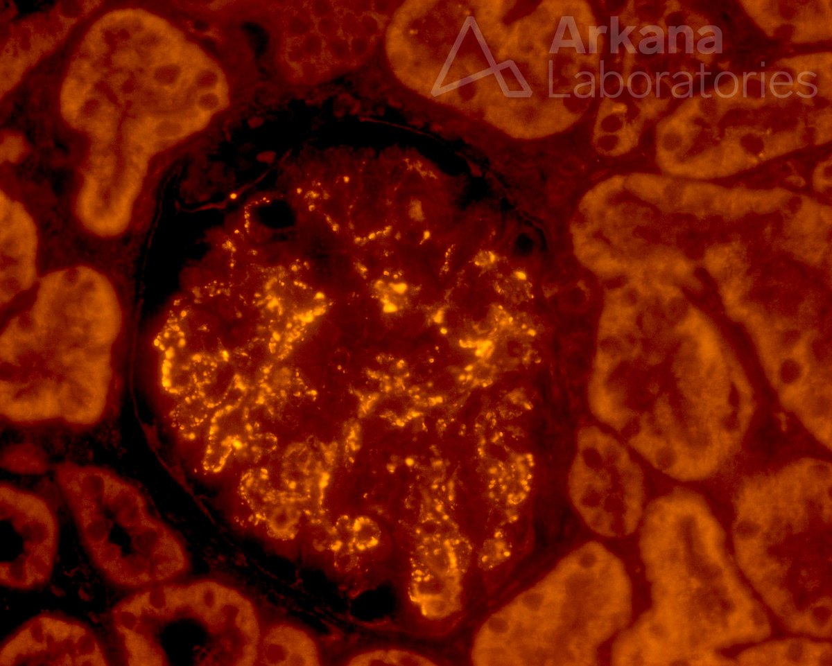 arkanalabs's tweet image. This image is from a biopsy of a young female who presented with proteinuria during pregnancy. Routine immunofluorescence was negative. What is this stain and what is your diagnosis?

#DiagnoseThis #nephx #pathx #renal #kidneypath