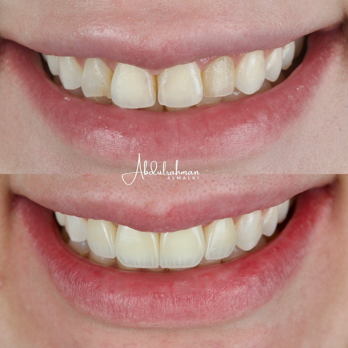أربع أسنان فقط كانت كافية لتعيد الثقة والانسجام للابتسامة.
البساطة أحيانًا هي مفتاح الجمال.

#تجميل_الأسنان #ابتسامة_طبيعية #ابتسامة_الرياض #زراعة_الأسنان #تركيبات_الأسنان #ابتسامة_هوليود #عيادة_الرياض #Prosthodontics #CosmeticDentistry #SmileDesign #DigitalDentistry