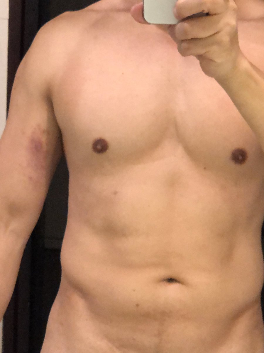 昨天做筋膜刀理療，怎看起來像家暴😭