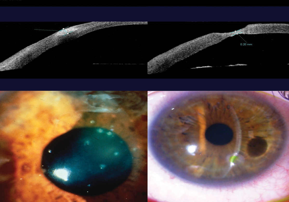 revoptom's tweet image. Corneal Ulcer Risks in Soft Contact Lens Wear: An Update

Despite advances in materials and care systems, microbial keratitis and related complications remain a significant concern for patients and providers alike: revieweducationgroup.com/ce/corneal-ulc…
#optometrist #optometry #cornea #vision