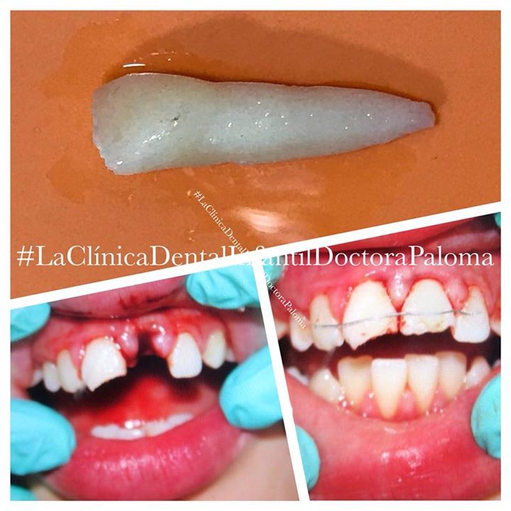 Tu hijo se cae jugando al futbol. Pierde un diente. Te entra PÁNICO. 😱

Lo que hagas en los PRÓXIMOS 15 MINUTOS puede significar que tenga su diente de por vida o que lo pierda para siempre.

¿Sabes qué hacer? Te lo cuento 🧵