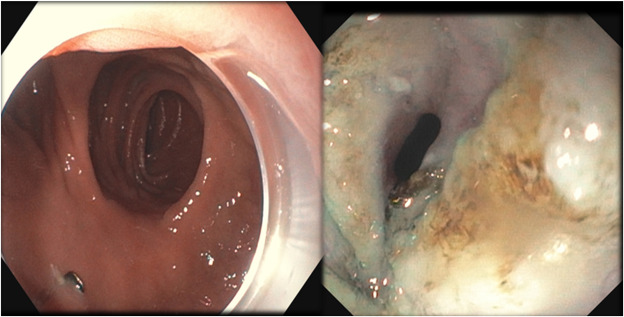 videogie's tweet image. Davekaran Buttar et al conduct &quot;Enhanced transoral outlet reduction using endoscopic submucosal dissection and zipper-type suture technique after Roux-en-Y gastric bypass.&quot; videogie.org/article/S2468-…

#GITwitter