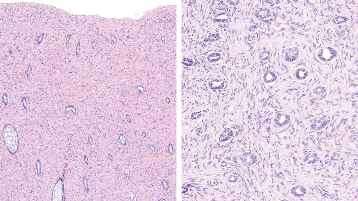 Ovarian Cancer

It is very easy to understand how ovarian cancer develops by looking at benign tumors. The numerous glands seen in adenofibromas are not connected to each other or to any epithelial area. These glands develop by way of mesenchymal-epithelial transition, which