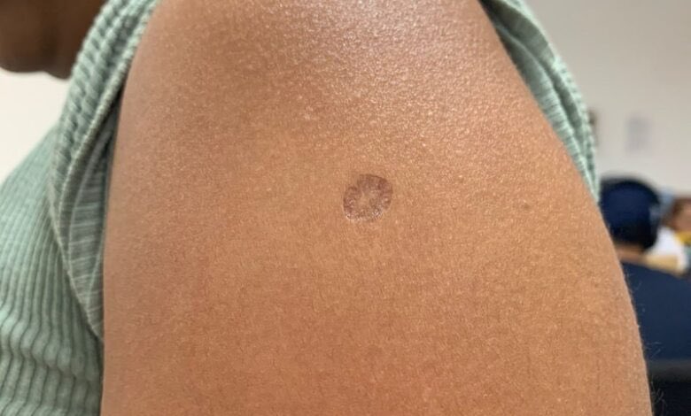 Si tenes esta marca en el brazo significa que tuviste padres presentes y que te quisieron mucho. Abrazo