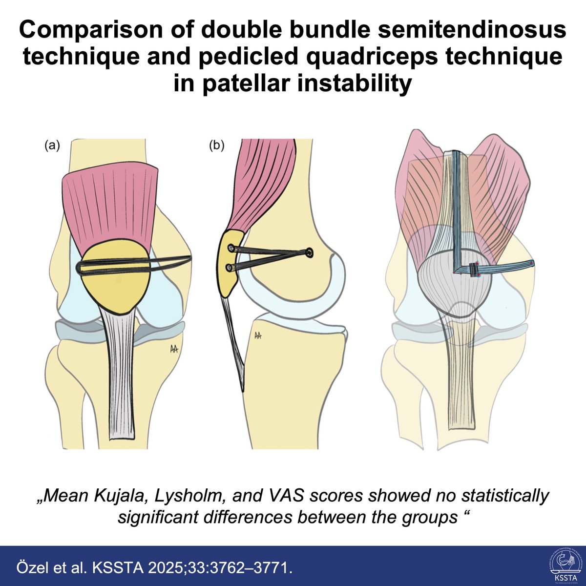 KSSTA's tweet image. Does it even matter, which surgical technique you use for MPFL reconstruction? Find out in this new KSSTA study.
 
#knee #patellofemoral #dislocation #openaccess #KSSTA
 
Read here: doi.org/10.1002/ksa.12…