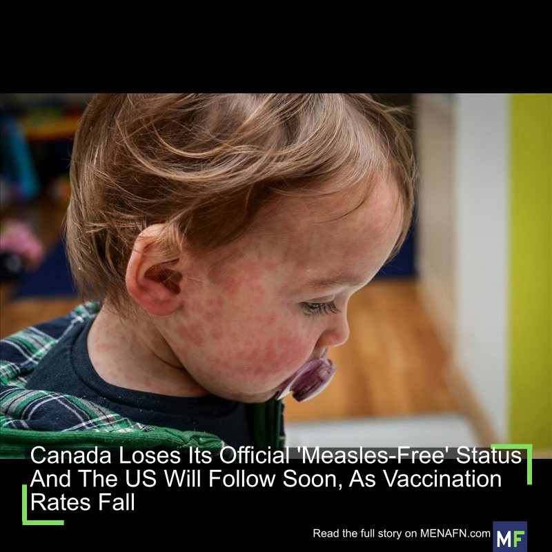 MENAFN's tweet image. Canada Loses Its Official 'Measles-Free' Status And The US Will Follow Soon, As Vaccination Rates Fall #Canada #Loses #Official #'Measles-Free' #Status #Follow #Soon, #Vaccination #Rates #Fall #Vaccines #Pills #Doctor #Hospital #Pandemic dlvr.it/TPBMnz