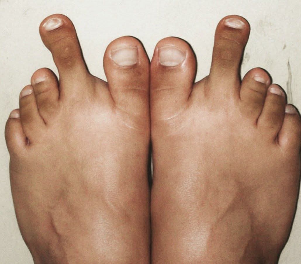 dr_ajabb's tweet photo. Morton's Toe https://t.co/g6MR7BYLAD