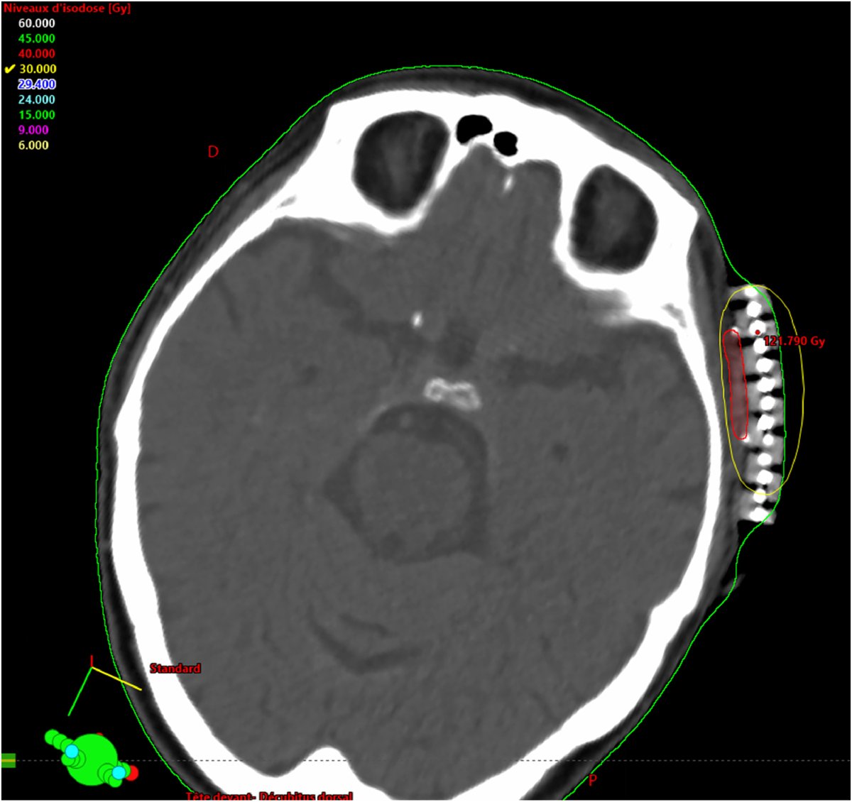 ASTRO_org's tweet image. New in #practicalRO: High-dose-rate (HDR) plesiotherapy with flap for the treatment of non-melanoma skin cancer. #radonc