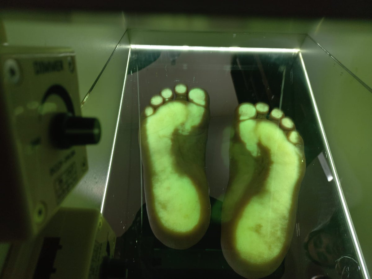 ✨ Hoy te contamos que más de 1.800 pacientes talquinos accederán a una terapia innovadora para el pie diabético 👣💙. La Municipalidad de Talca desarrolla plantillas ortopédicas personalizadas con tecnología 3D,  ➡️ talca.cl/?p=26169